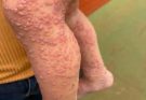 His whole body was itchy, he thought it was an allergy and was diagnosed…See more