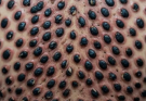 What Really Causes Acne? The Surprising Truth Behind Stubborn Breakouts