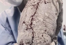 Baby born with an DIU peg… See more